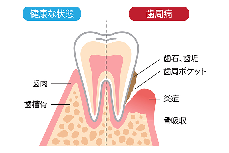 歯周病