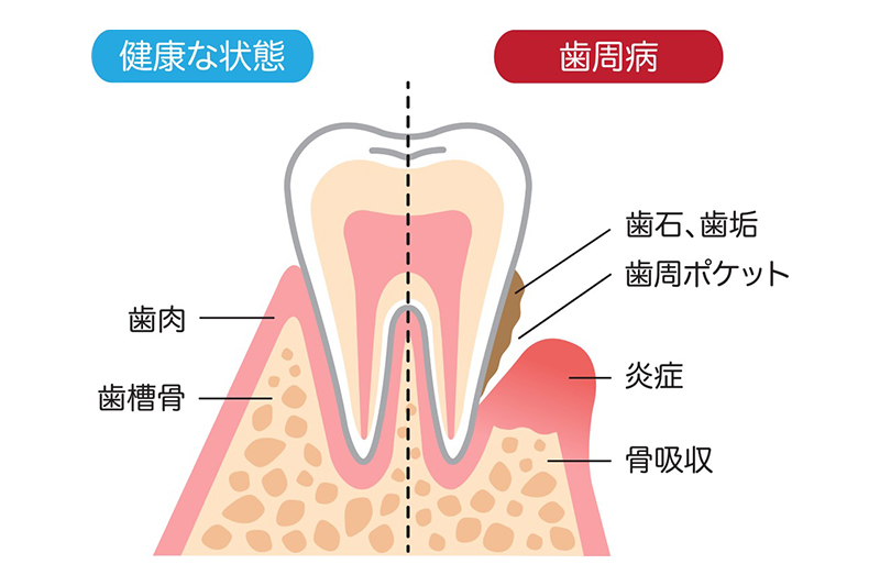歯周病とは